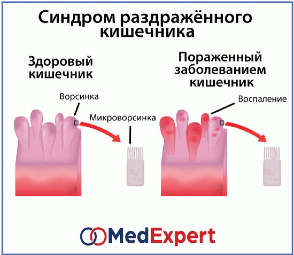 Лечение кишечника симптомы у взрослых синдром раздраженного. Синдром раздражённого кишечника. Синдром раздраженного кишечника. Синдром раздраженного кишечника симптомы. Синдром раздраженной кишки симптомы.