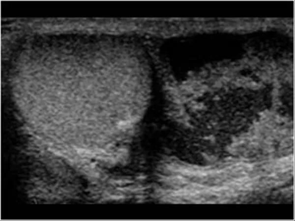 Эпидидимит, орхит, орхоэпидидимит. Эпидидимит УЗИ картина. Хронический эпидидимит на УЗИ. Гонококковый эпидидимит.