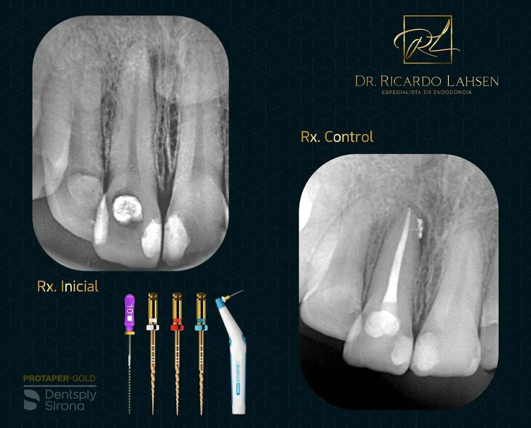 En que consiste una endodoncia