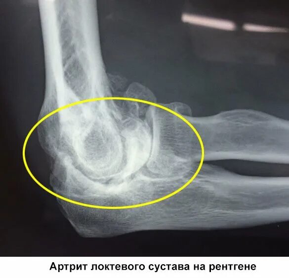 Уплотнена деформирована