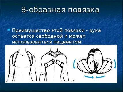 Кольца при переломе ключицы