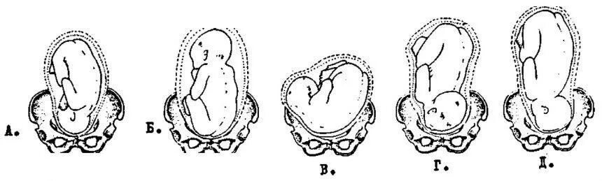 Сгибательные предлежания плода. Передний вид затылочного предлежания. Затылочное предлежание 2-я позиция. Задний вид затылочного предлежания. Заднее предлежание плода