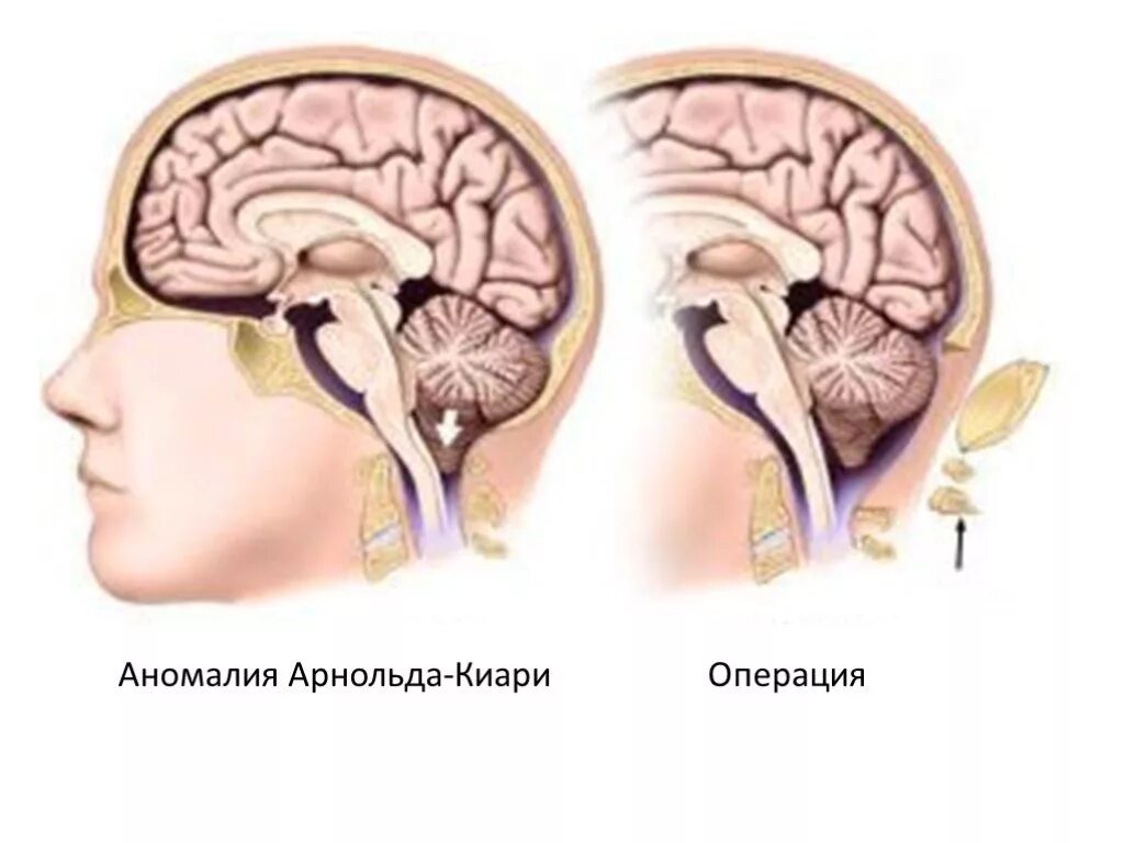 Аномалия киари степени. Мальформации Арнольда-Киари. Мальформация Арнольда-Киари 2 типа. Аномалия Арнольда Киари у детей. Аномалия Арнольда-Киари 1 типа у ребенка операция.