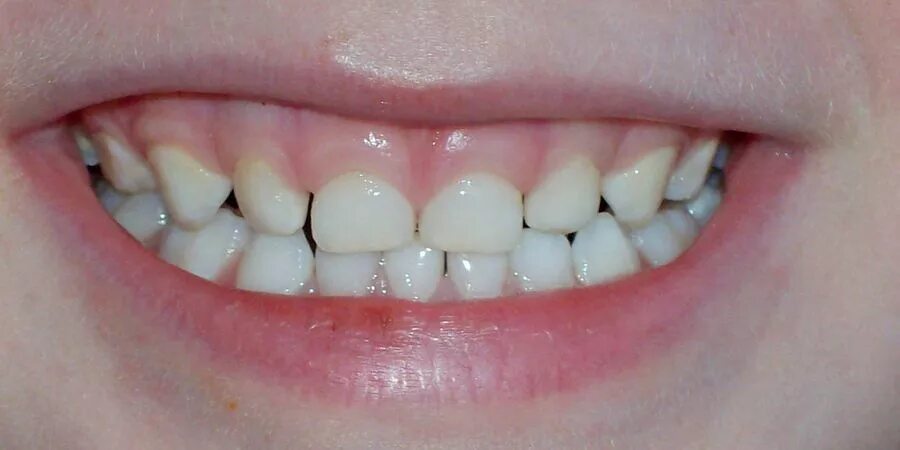 молочный прикус у детей. молочный прикус у детей. неправильный прикус у ребенка. ровные зубы у детей. молочный прикус у детей.