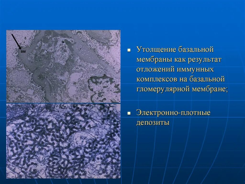Электронно плотный. Отложения иммунного комплекса на базальной мембране. утолщение мембраны легких. электронно плотные депозиты это. отложение электронно-плотных депозитов.