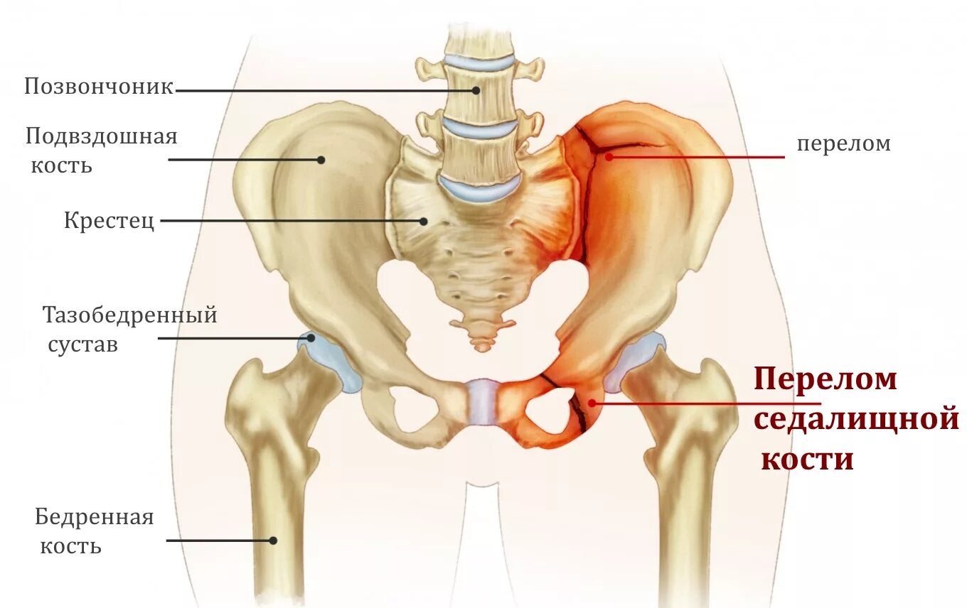 Кость где бедро. Трещина подвздошной кости таза. Подвздошная седалищная и лобковая кости. Тазобедренный сустав седалищная кость. Перелом лобковой седалищной кости.