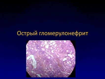 Нефрит и нефроз