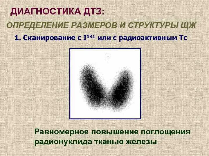 Диагноз диффузно токсический зоб. Диффузный токсический зоб диагностика. диффузный токсический зоб картинки. диффузно токсический зоб лейкоформула. диффузно токсический зоб памятка.