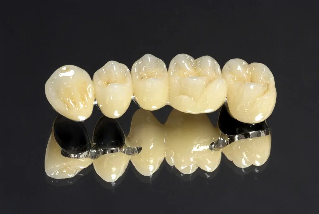 Металлопластмассовый мостовидный протез. Мостовидные коронки на зубы. Металлокерамика коронки протез мостовидный.
