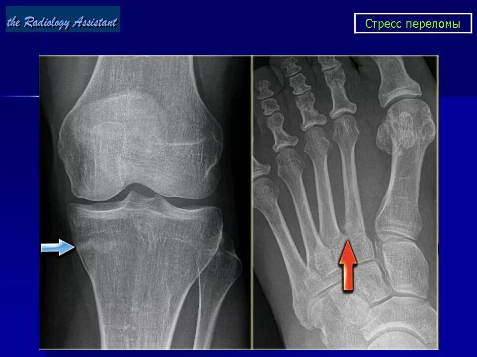 Стрессовый перелом 5 плюсневой кости. Стрессовый перелом большеберцовой кости. Маршевый перелом большеберцовой кости. Перелом плюсневой кости рентген.