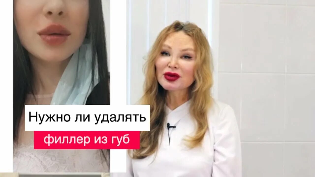 Удаление филлера из губ до и после Хейлопластика увеличение губ хирургическим путем "Хейлопластика VY все за и