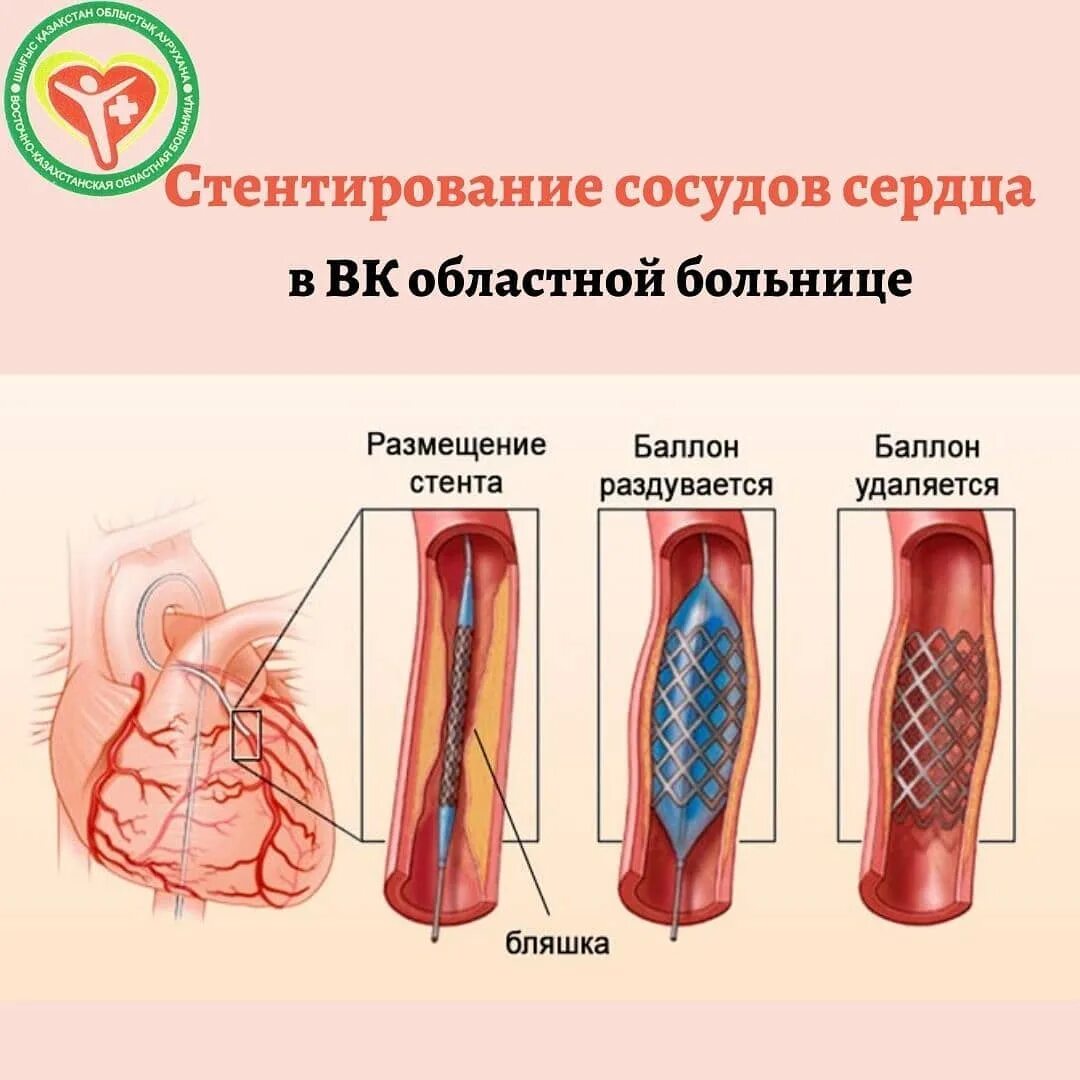 Стентирование сердца что это такое. Операция стентирование сосудов сердца. коронарография стентирование сосудов сердца. стентирование коронарных артерий схема. стентирование коронарных сосудов сердца при инфаркте.