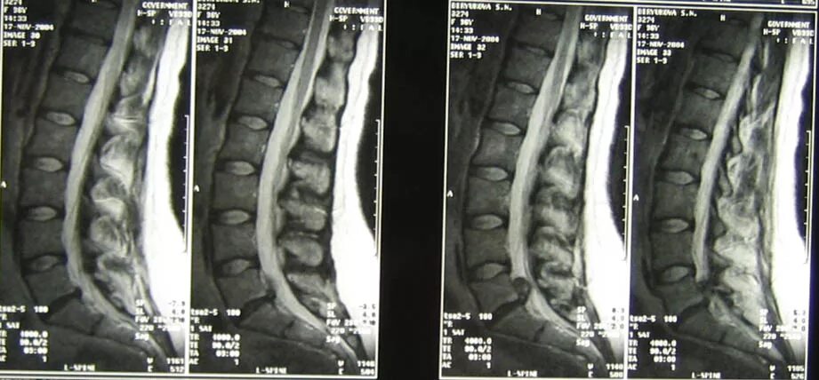 После операции на крестцовый отдел позвоночника. Диски l5-s1 в позвоночнике. Грыжа l5-s1. Снимки пояснично крестцового отдела грыжи l5-s1. Секвестрированная грыжа l5-s1 операция.