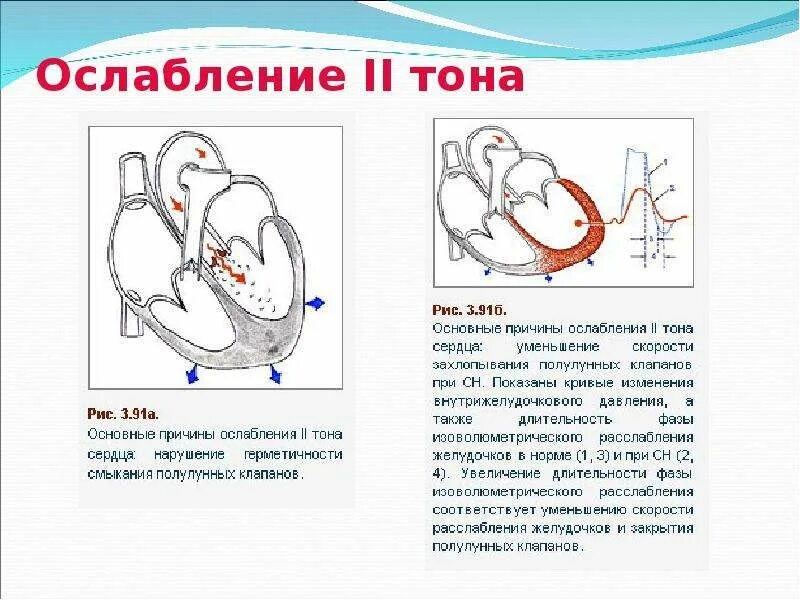 Ослабленные тоны сердца. Ослабление 2 тона на легочной артерии. Аортальный стеноз 2 тон. Причины ослабления II тона на легочной артерии.. Аускультация сердца тоны при аортальном стенозе.