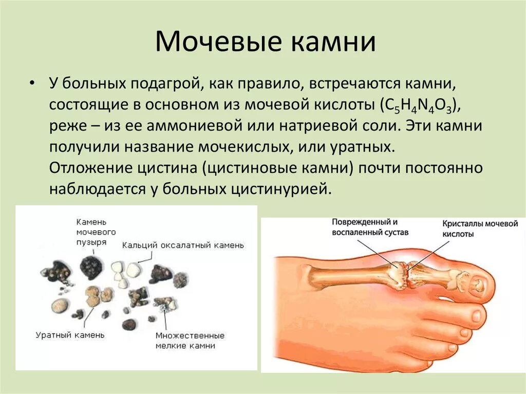 Против мочевой кислоты. Камни мочевой кислоты в почках. Камни из мочевой кислоты в почках. Соль мочевой кислоты камни.