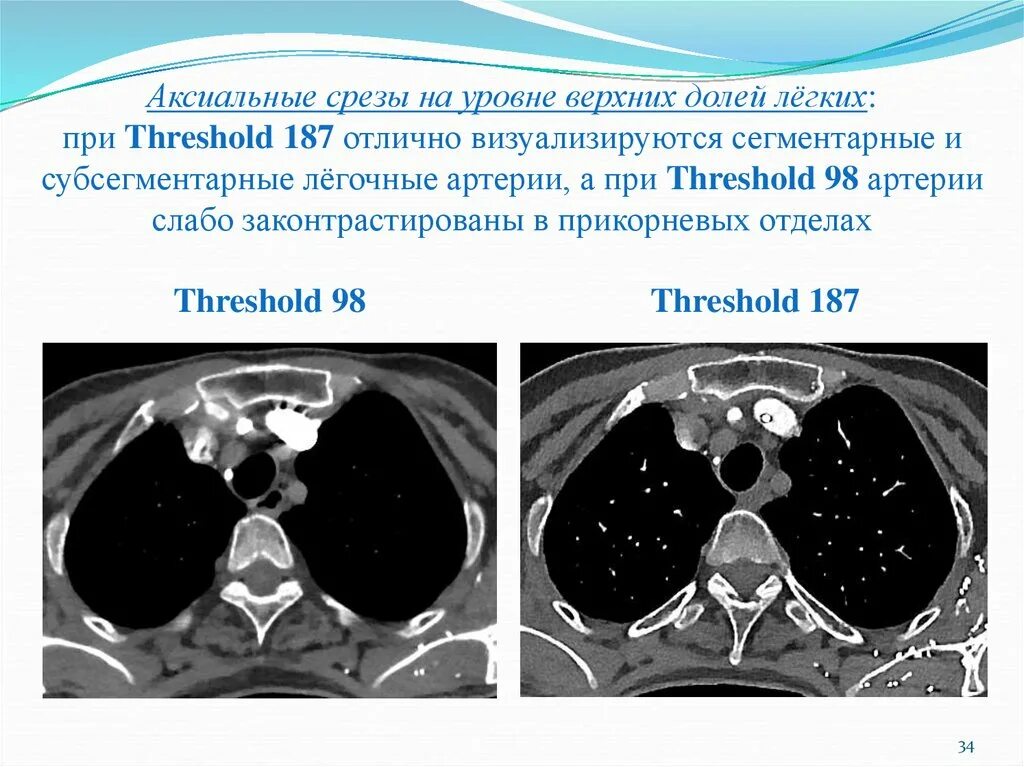 Мультиспиральная компьютерная томография легких. Срезы на кт виды. Аксиальный срез брюшной полости. Аксиальный срез кт. Кт томограф 64 среза.