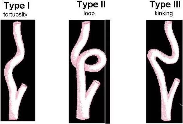 Изгиб вса. Патологическая извитость сонных артерий кинкинг. S-образная извитость внутренней сонной артерии. Патологическая извитость ВСА. Патологическая деформация ВСА.