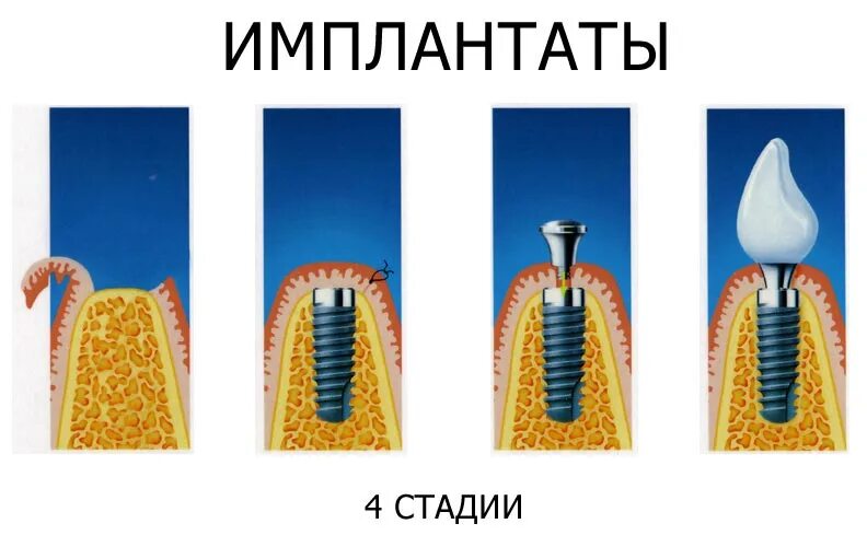 Этапы имплантации зубов. Двухэтапная имплантация имплантация.