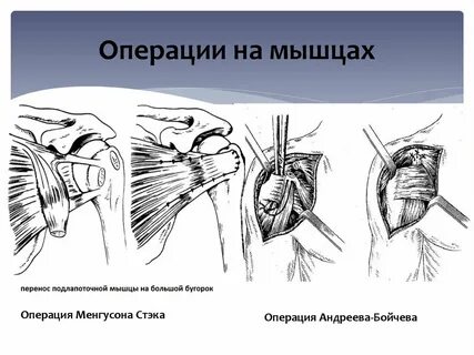 Привычный вывих плечевого сустава