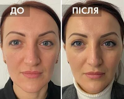 Липофилинг москва