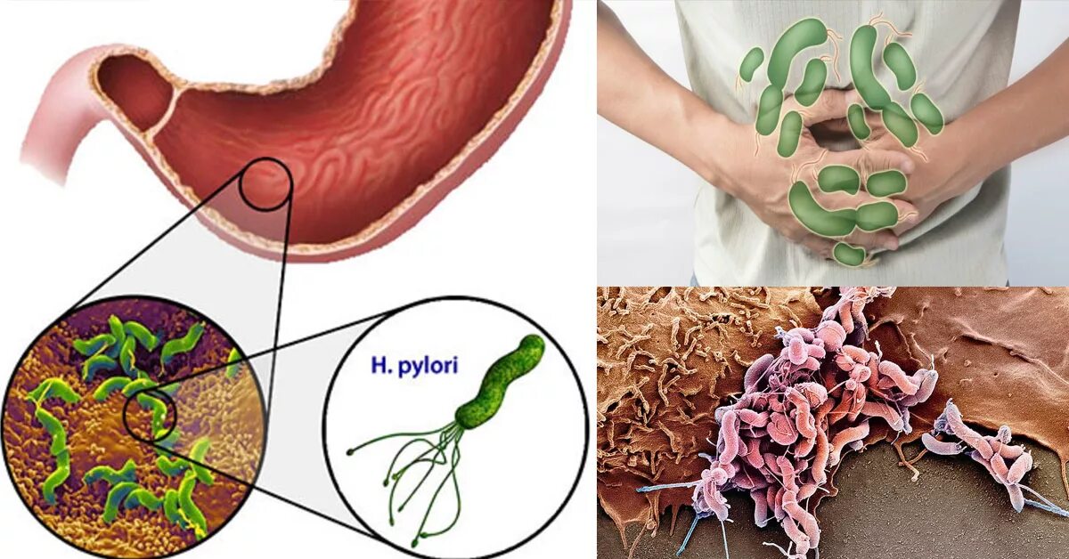 Хеликобактер пилори язвенная болезнь. Язва желудка хеликобактер пилори. Пилорический хеликобактер. Инфицированность хеликобактер.