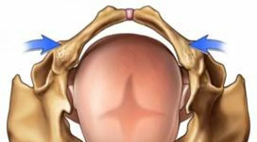 Формы узкого таза в акушерстве. Перекос асимметрия таза. Ли таз. Аномалии костей таза акушерство. Ли таз.