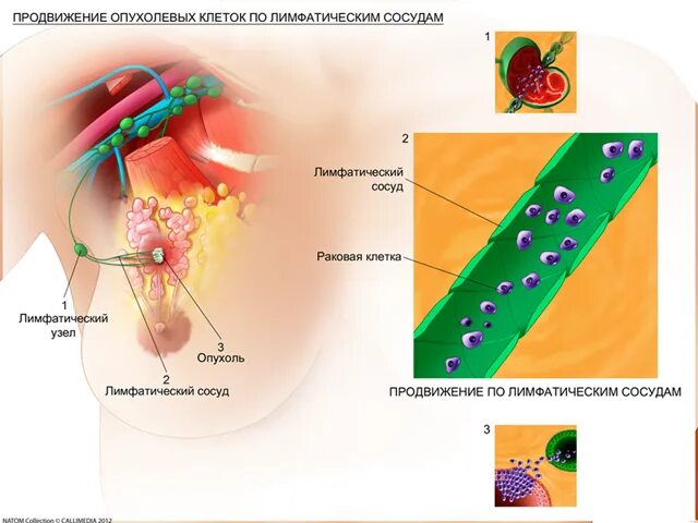 Классификация метастазов. Так прямой кишки метастазируеь. Метастазы при раке кишечника прогноз. Стадии онкологии прямой кишки. Стадии опухоли прямой кишки.