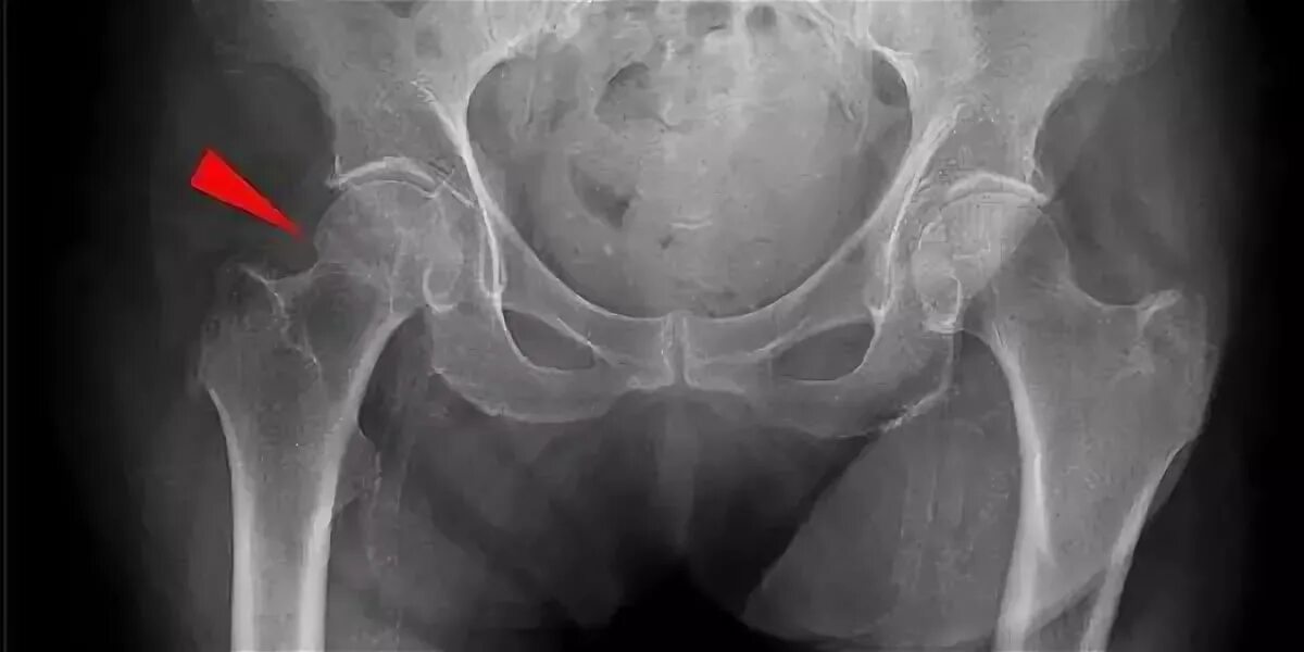 Субкапитальный перелом бедра. Вколоченный перелом шейки бедра рентген. Вколоченный перелом шейки бедренной кости. Субкапитальный вколоченный перелом шейки бедра рентген. Врач шейка бедра