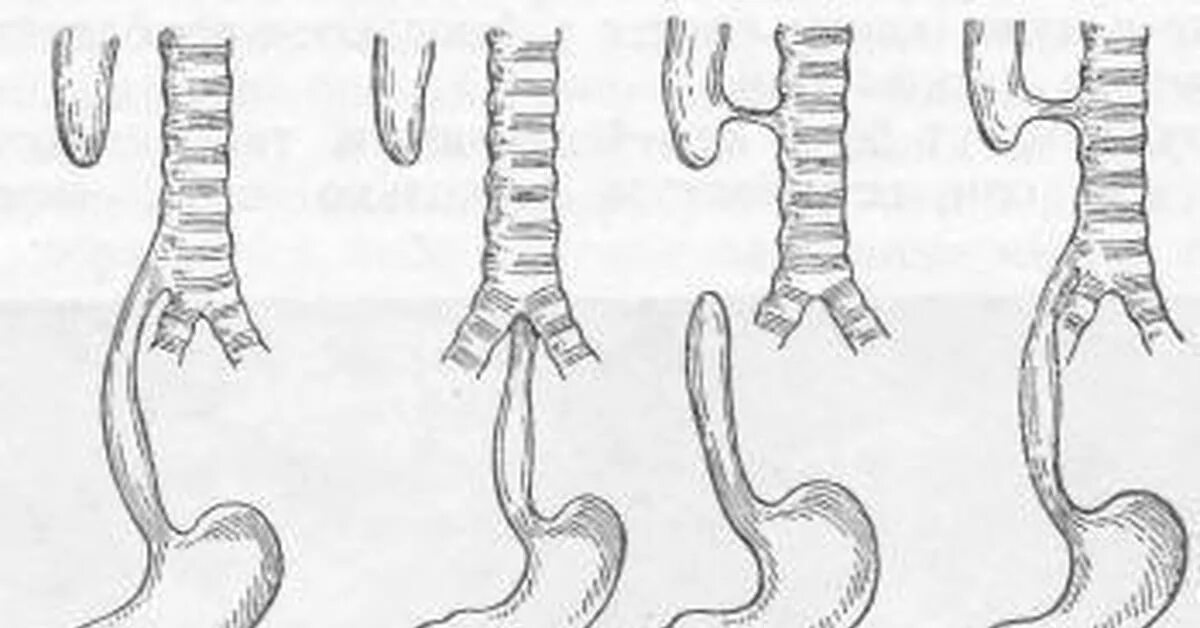 Трахеопищеводный свищ у новорожденных. Врожденный пищеводно-трахеальный свищ это. Трахеопищеводный свищ клиника. Трахеобронхиальный свищ. Пищевод у новорожденного