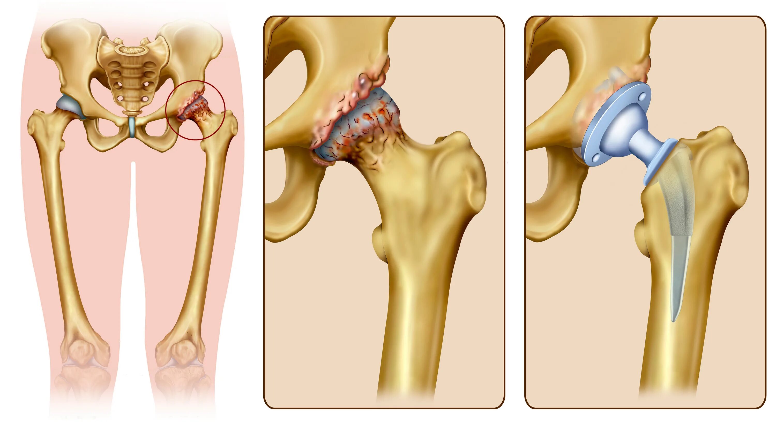 Медицина суставы тазобедренный. Коксартроза тазобедренного сустава. Коксартроз тазобедренного сустава 4. Первичный двухсторонний коксартроз тазобедренного сустава. Коксартроз 2 степени тазобедренного.