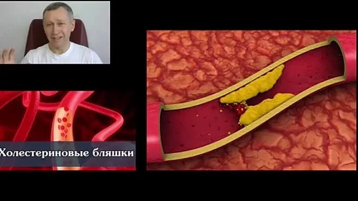 Бляшки уменьшились. Склеротические бляшки в сосудах под микроскопом. Бляшки уменьшились. Растворение холестериновых бляшек. Бляшки уменьшились.