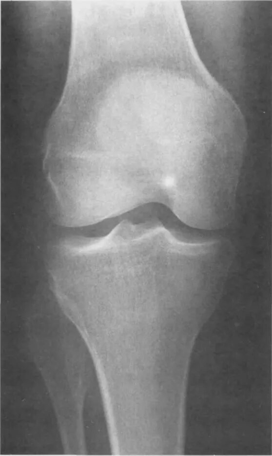 Эностоз большеберцовой кости. Мыщелок коленного сустава перелом. Мыщелок большеберцовой кости. Мыщелок коленного сустава большеберцовой кости.