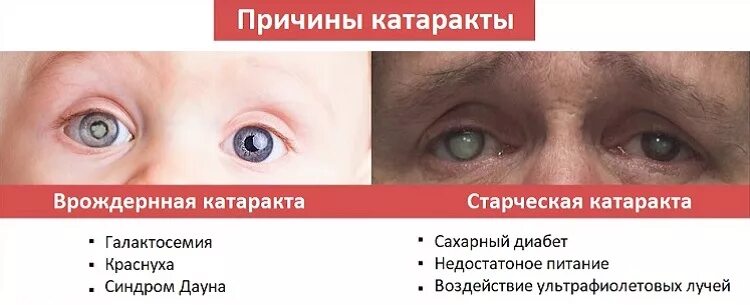 факторы возникновения катаракты. катаракта причины и профилактика. причины развития катаракты. факторы риска каратакры. катаракта на щелевой лампе.