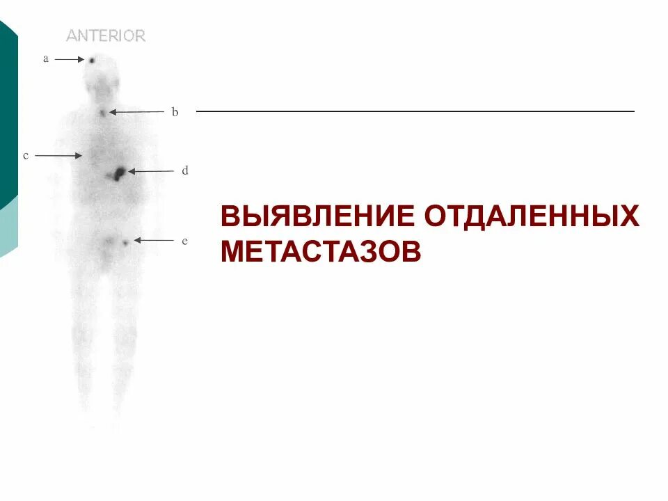 Метастазы при раке щитовидной железы. Метастазы опухоли щитовидной железы. Метастазирование щитовидной железы. Метастазы щитовидной железы в легких. Выявлены отдаленные метастазы.