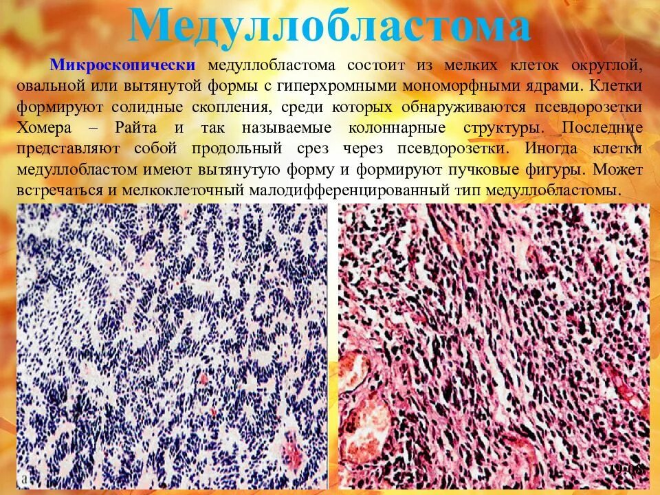 Медуллобластома клетки. Медуллобластома микропрепарат. Медуллобластома гистология. Клетки с гиперхромными ядрами