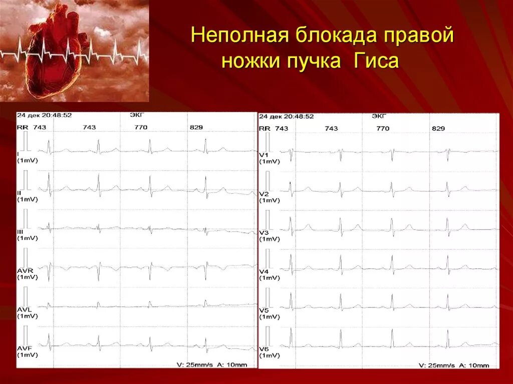 Опасна ли неполная блокада. Неполная блокада правой ножки пучка Гиса на ЭКГ. Неполная блокада ПНПГ на ЭКГ. Неполная блокада правой ножки на ЭКГ. Неполная блокада правой ножки пучка на ЭКГ.