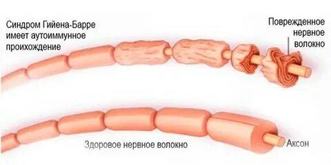 Синдрома гийена барре что это простыми
