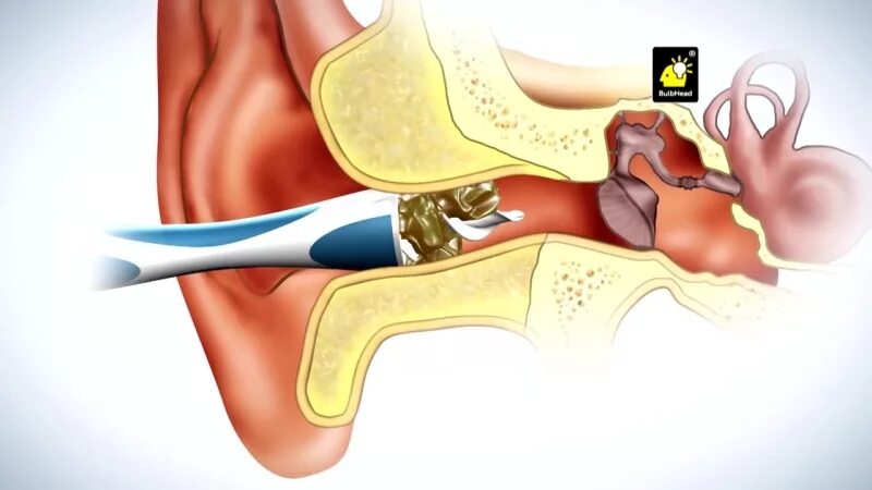 Очиститель ушей Smart Swab. Можно в домашних условиях убрать пробку