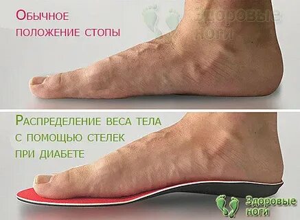 Признаки сахарной стопы