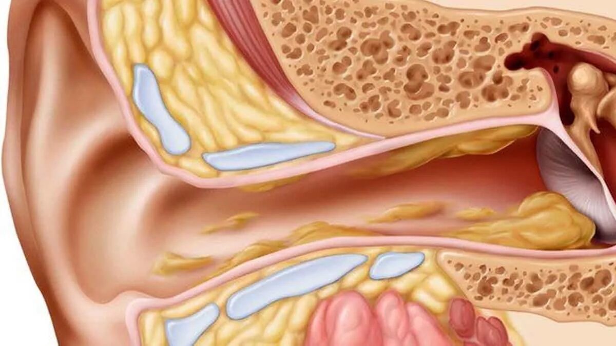 Строение уха сера в ухе. Строение уха с серной пробкой. Анатомия уха серная пробка. Наружный отит серная пробка. Почему в ушах образуется.