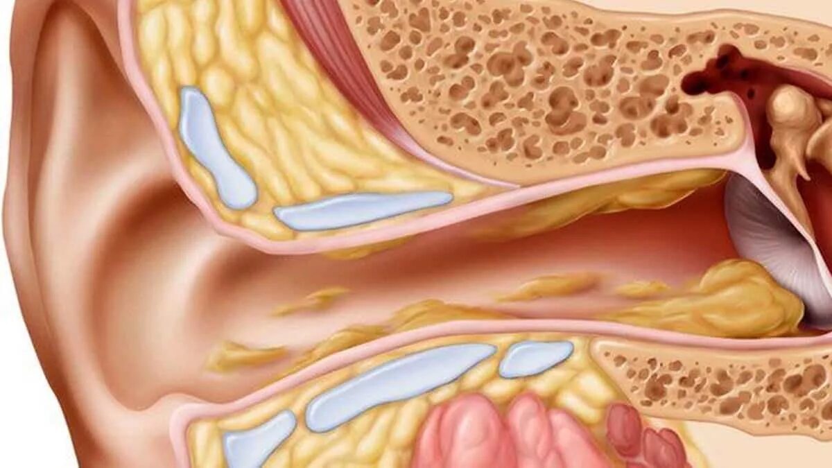 Почему образуется сера. Серная пробка на барабанной перепонке. Отомикоз серная пробка. Анатомия уха серная пробка.