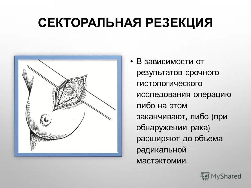 Реконструктивная хирургия молочной железы. Операция секторальная резекция молочной железы. секторальная резекция молочной железы фиброаденома. секторальная резекция молочной железы ход операции. эксцизия опухоли молочной железы.