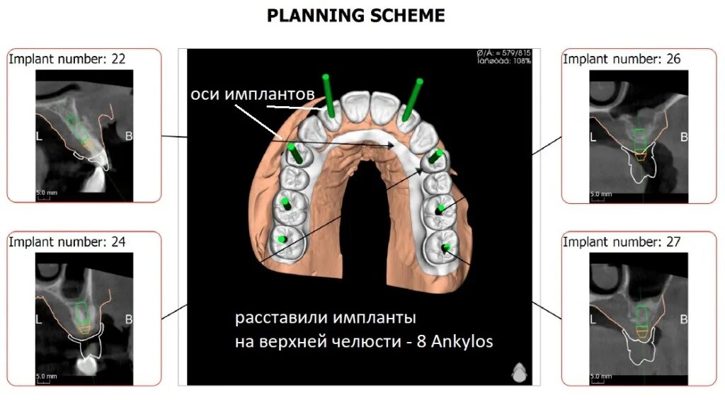 Можно ставить импланты при диабете. Наращивание кости верхней челюсти для имплантов. Наращивание челюстной кости для имплантов. Наращивание костной ткани для имплантов. Планирование дентальной имплантации.