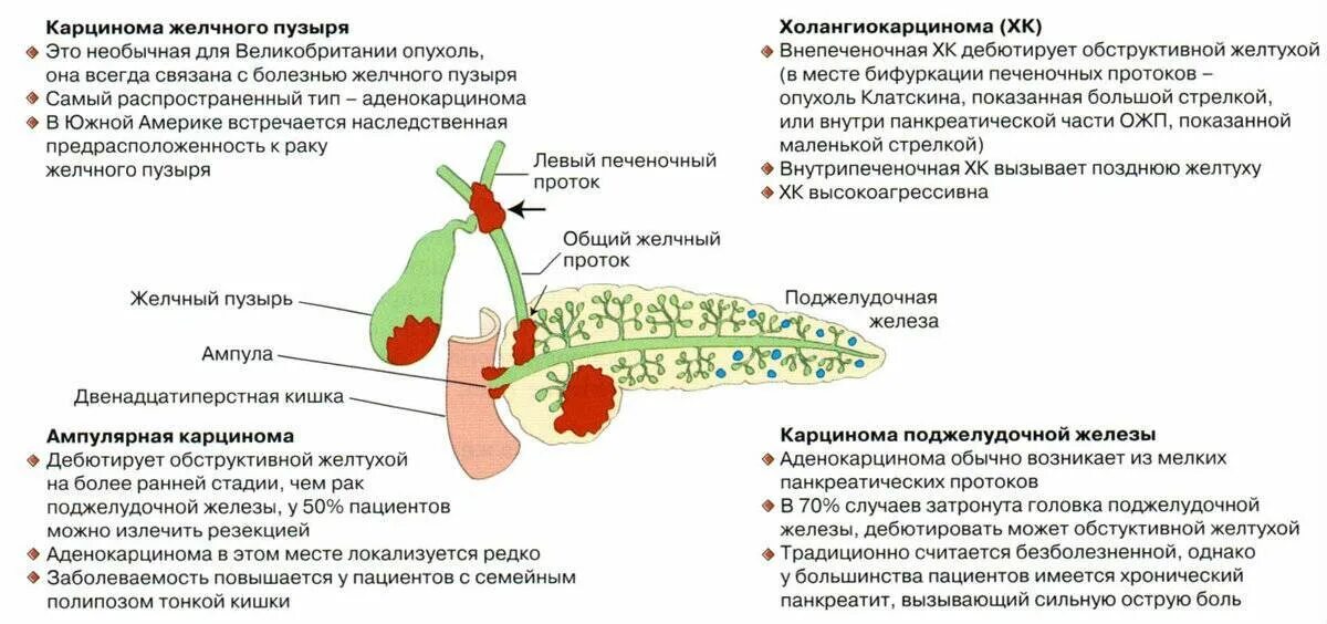 Как болит желчный симптомы у мужчин. Протоки желчного пузыря. Опухоли внепеченочных желчных протоков. Печень, желчный пузырь и желчные протоки. Классификация заболеваний. Опухоль желчного пузыря.