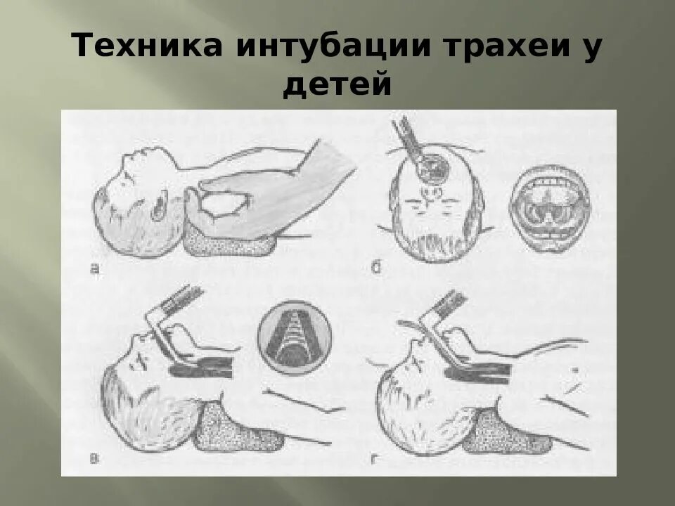 Прием при интубации