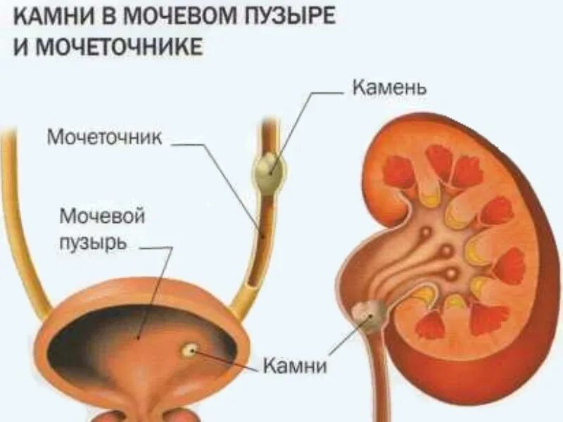 Удалили мочевой пузырь мужчине. Мочевыделительной системы мочевой пузырь. Мочекаменная болезнь камни в мочевом пузыре. Камни в почках мочеточнике и мочевом пузыре. Мочеполовой системы - мочекаменная болезнь.