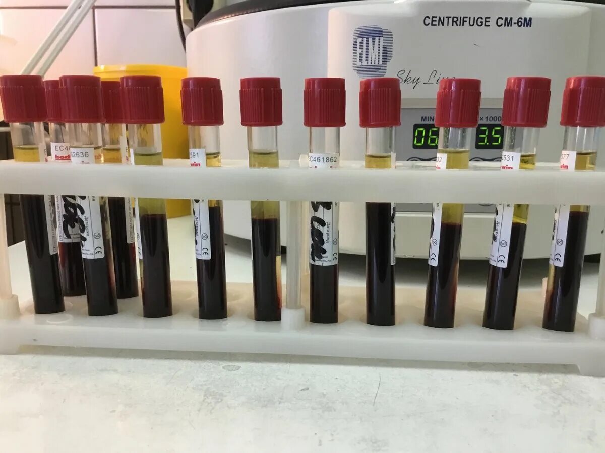 Гемолиз хилез. Сыворотка крови пробирки с ЭДТА. Хилёзная сыворотка крови что это.