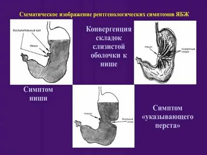 Симптом ниши