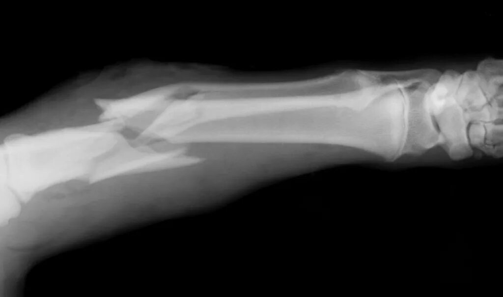 Открытая трещина. Рентгенограмма перелом кости. Перелом берцовой кости рентген. Открытый перелом рентген.