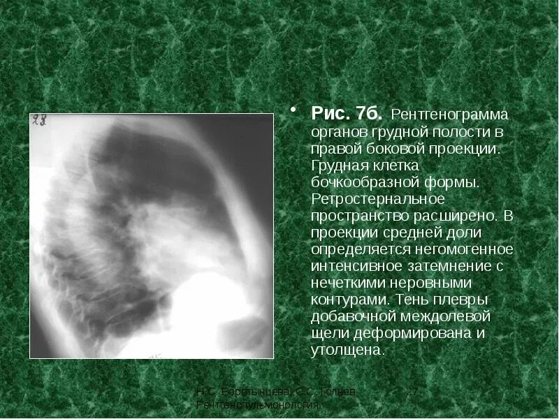 Протокол описания рентгена грудной клетки. Нечеткие неровные контуры. Усиление сосудистого рисунка легкого. Медиастинальный осумкованный плеврит. Обширное затемнение легочного поля.